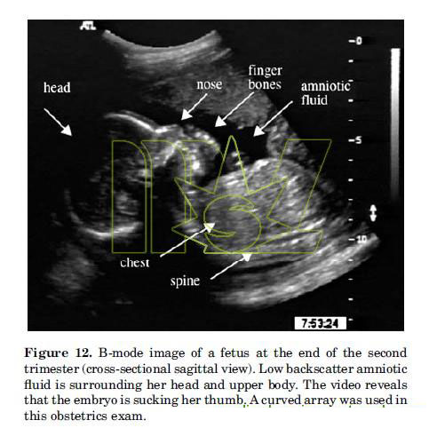 B-mode of the ultrasound  Download Scientific Diagram