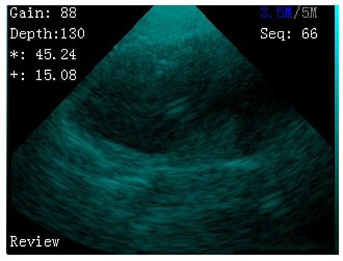 handheld ultrasound image