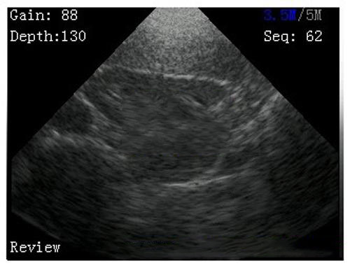 handheld ultrasound imaging