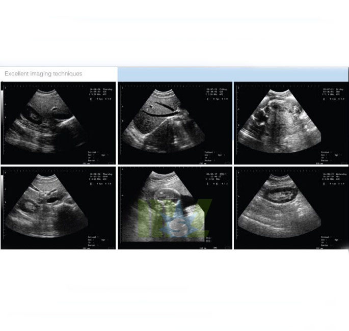 best portable ultrasound machine MSLPU28 Excellent Diagnostic picture