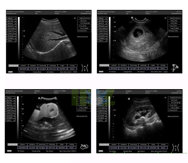 3d full digital laptop ultrasound scanner MSLPU30