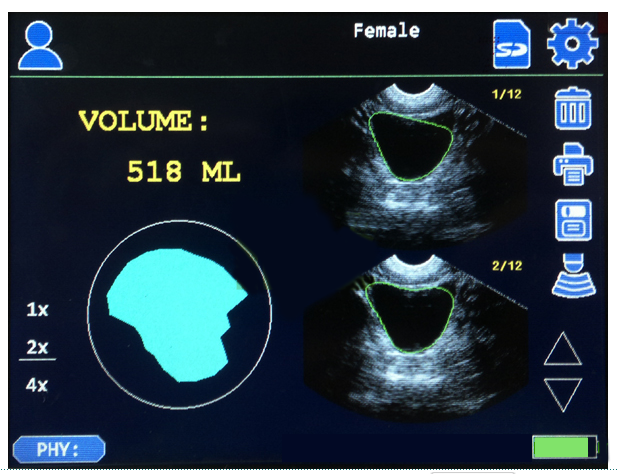 BladderScan / bladder scan ultrasound