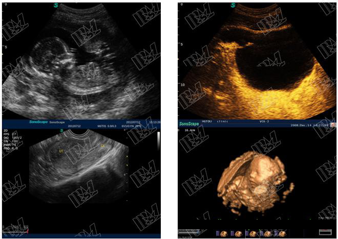 doppler vascular ultrasound SonoScape S11