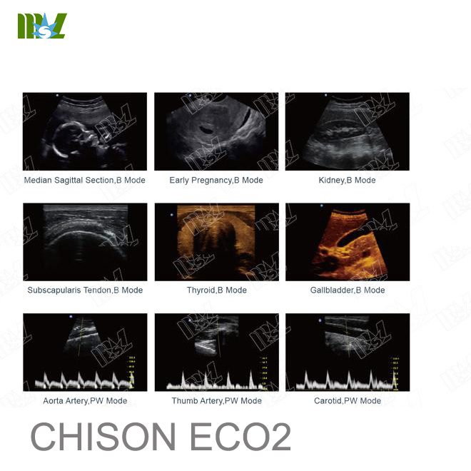 musculoskeletal sonography chison eco 2