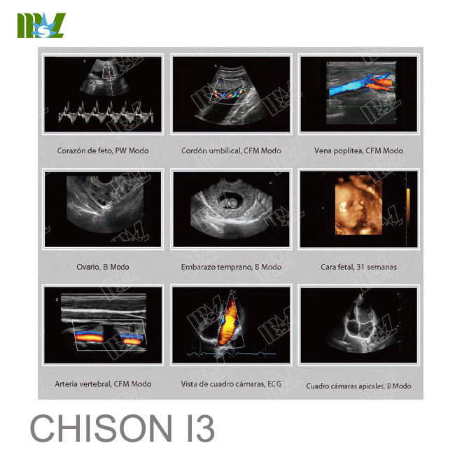ultrasonido abdominal chison i3