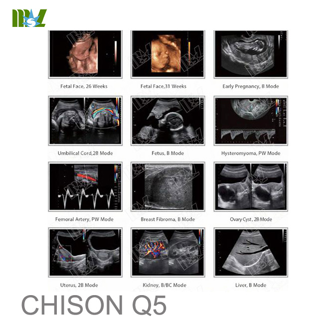 chison ultrasound chison q5