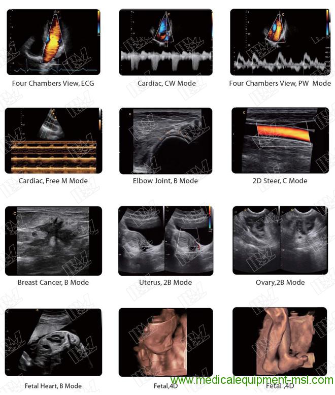Chison ultrasound