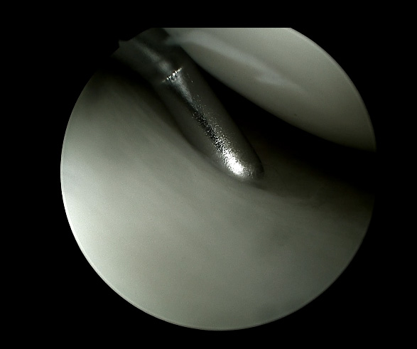 HD rigid endoscope