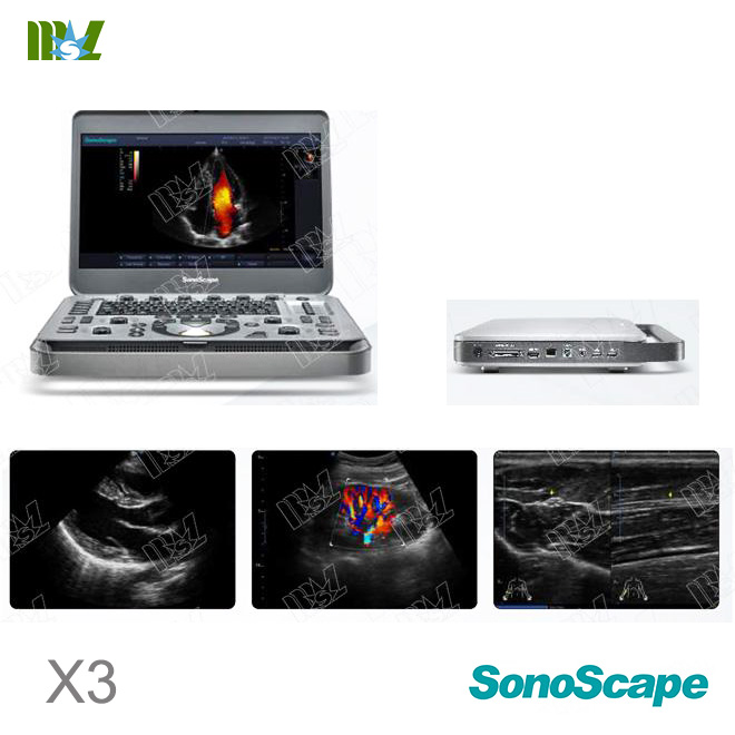 Eco doppler carotidian SonoScape X3 price : ecografie transfontanelara