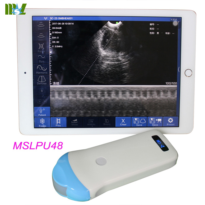 wireless ultrasound probe