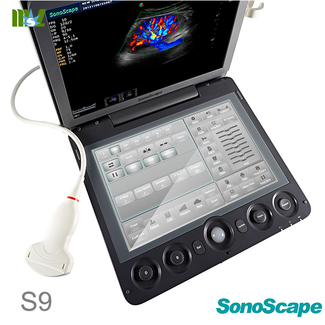 sonoscape S9 heart ultrasound