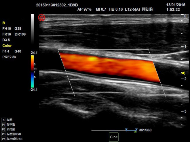 vascular ultrasound